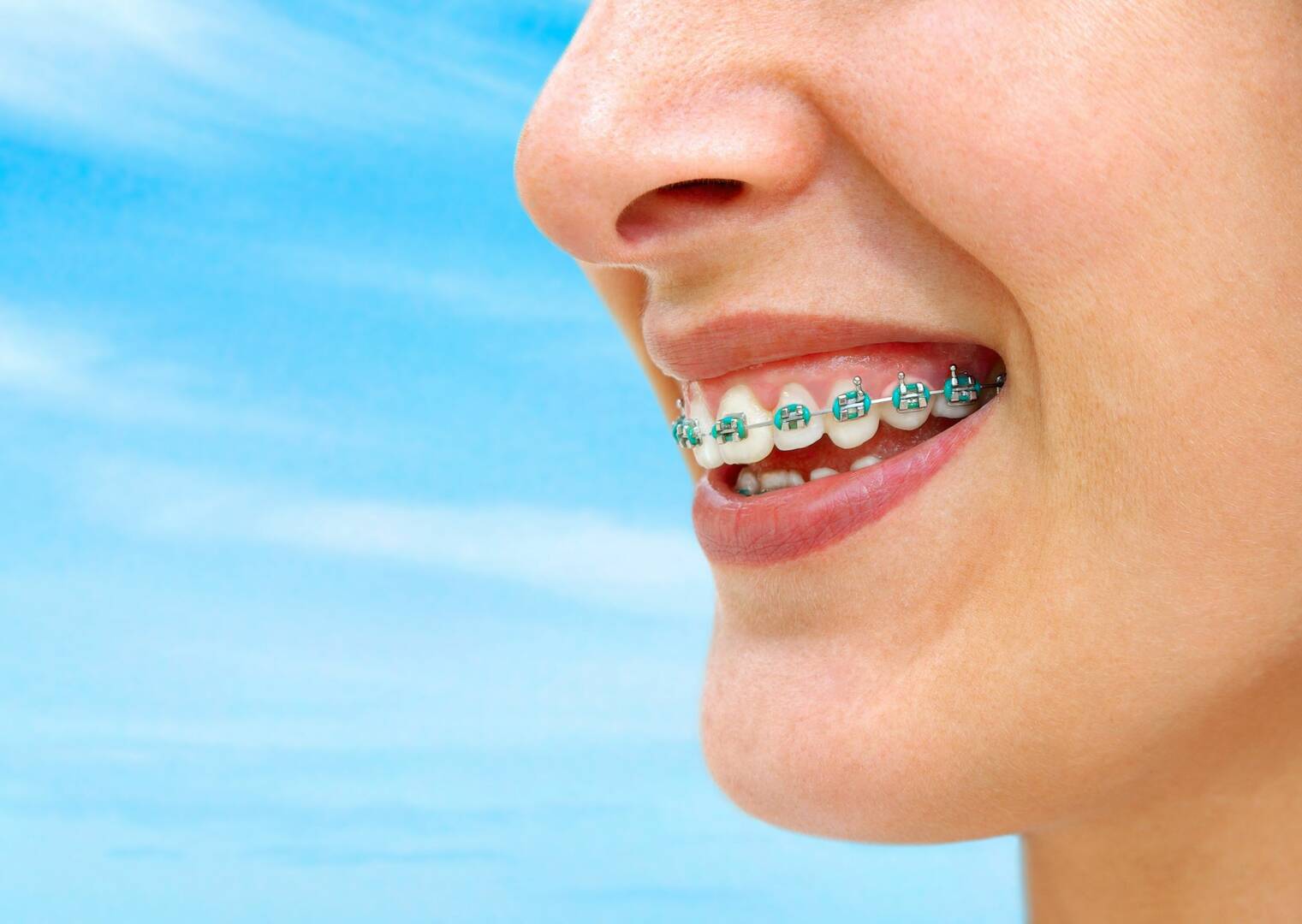 Braces Bedford Tx